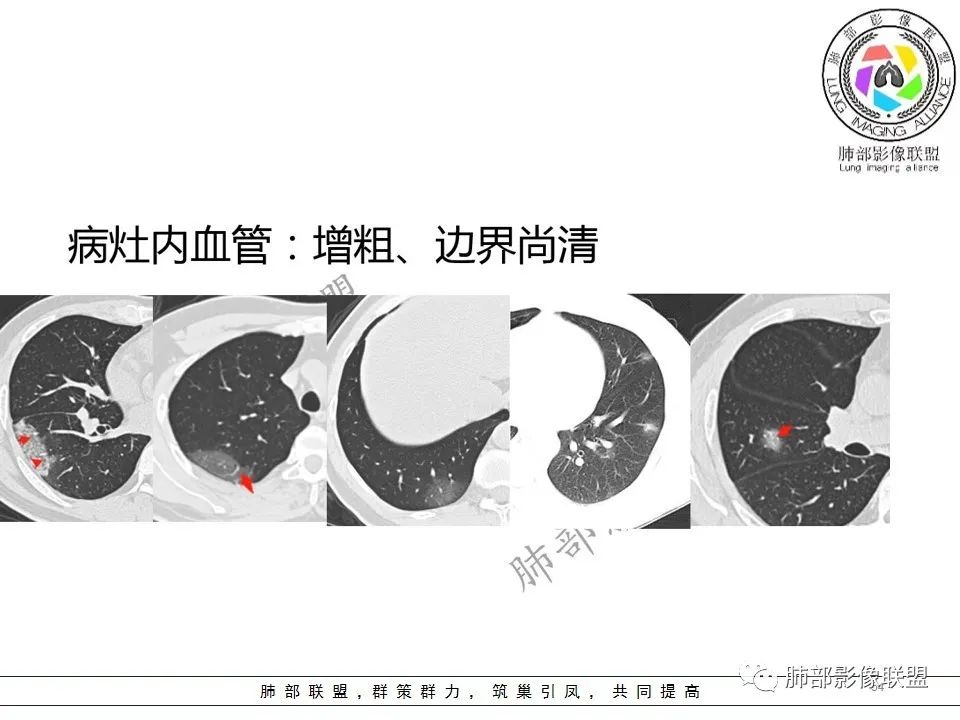 【PPT】关于180余例新冠肺炎(NCP)的影像分析与思考