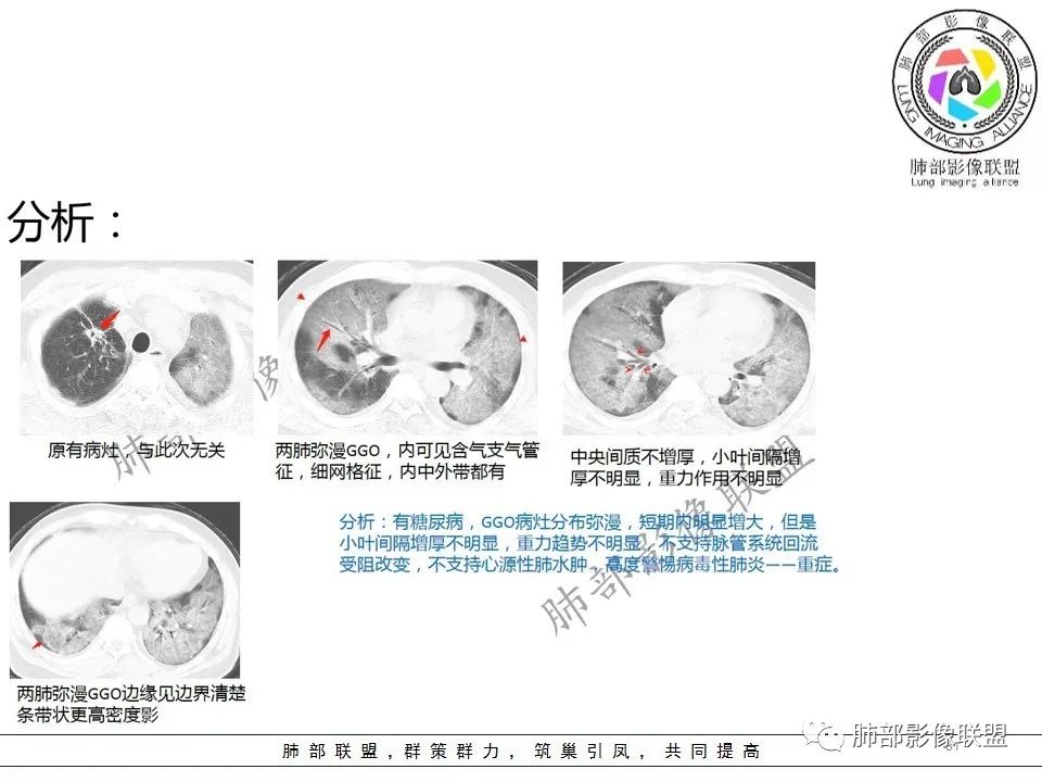 【PPT】关于180余例新冠肺炎(NCP)的影像分析与思考