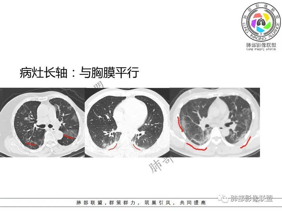 【PPT】关于180余例新冠肺炎(NCP)的影像分析与思考