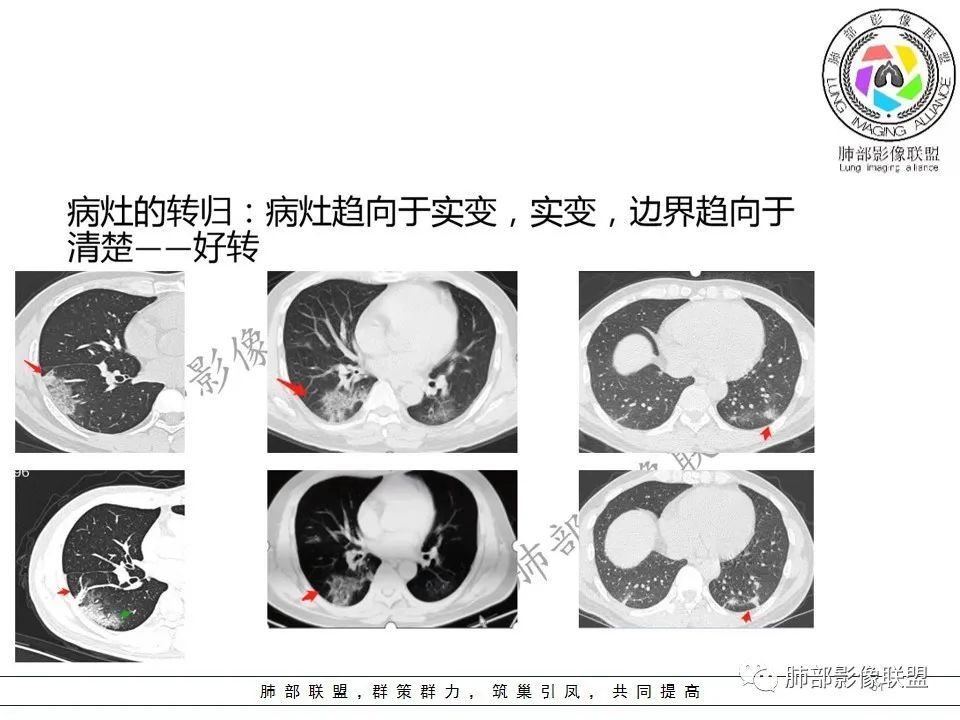 【PPT】关于180余例新冠肺炎(NCP)的影像分析与思考