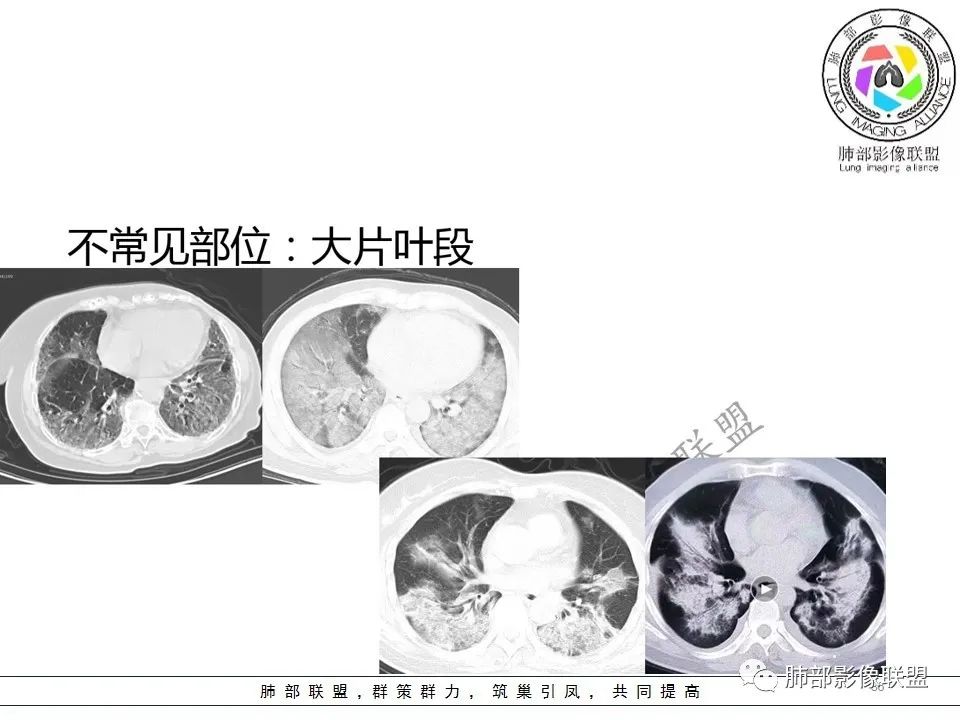 【PPT】关于180余例新冠肺炎(NCP)的影像分析与思考