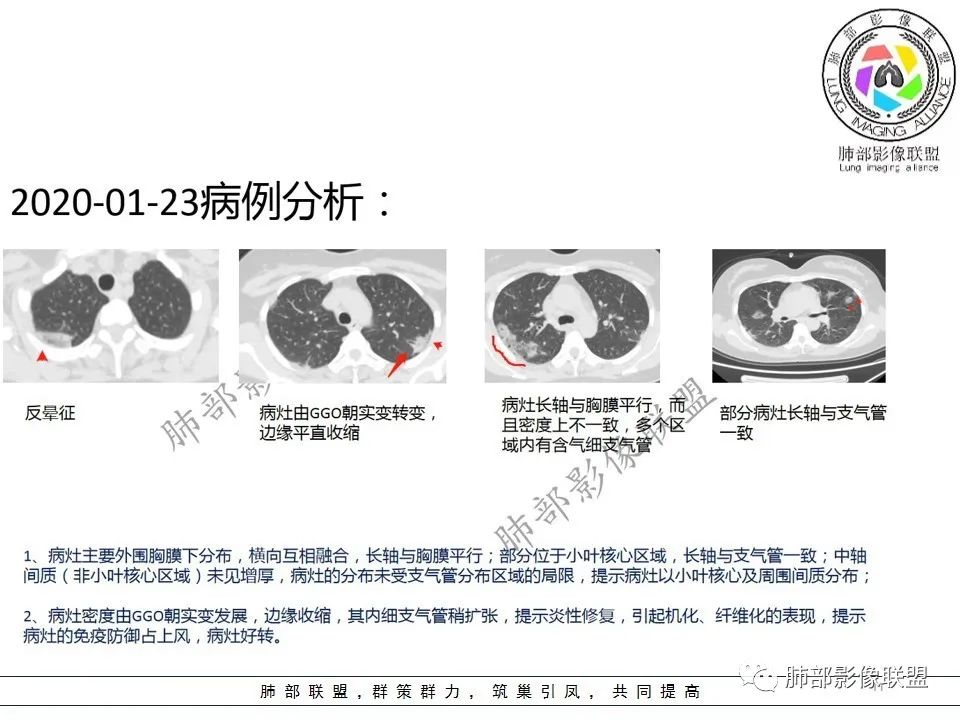 【PPT】关于180余例新冠肺炎(NCP)的影像分析与思考