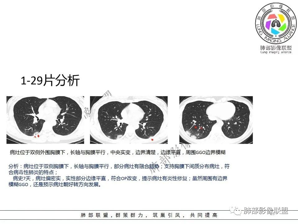 【PPT】关于180余例新冠肺炎(NCP)的影像分析与思考