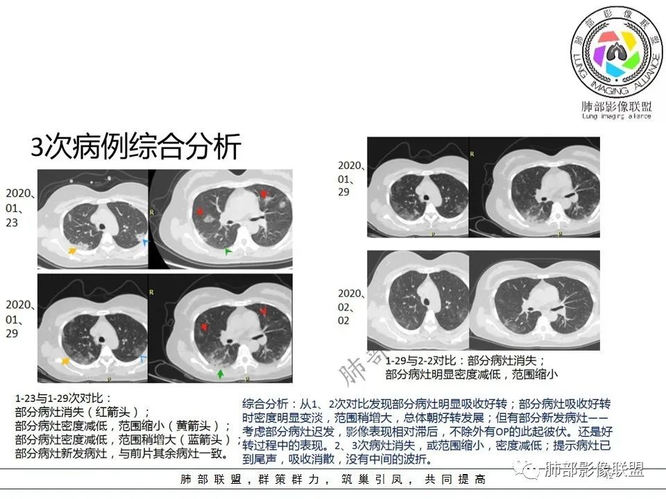 【PPT】关于180余例新冠肺炎(NCP)的影像分析与思考