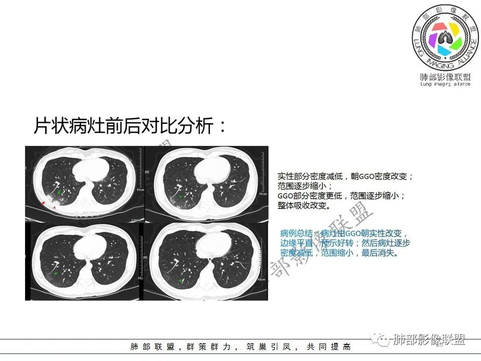 【PPT】关于180余例新冠肺炎(NCP)的影像分析与思考