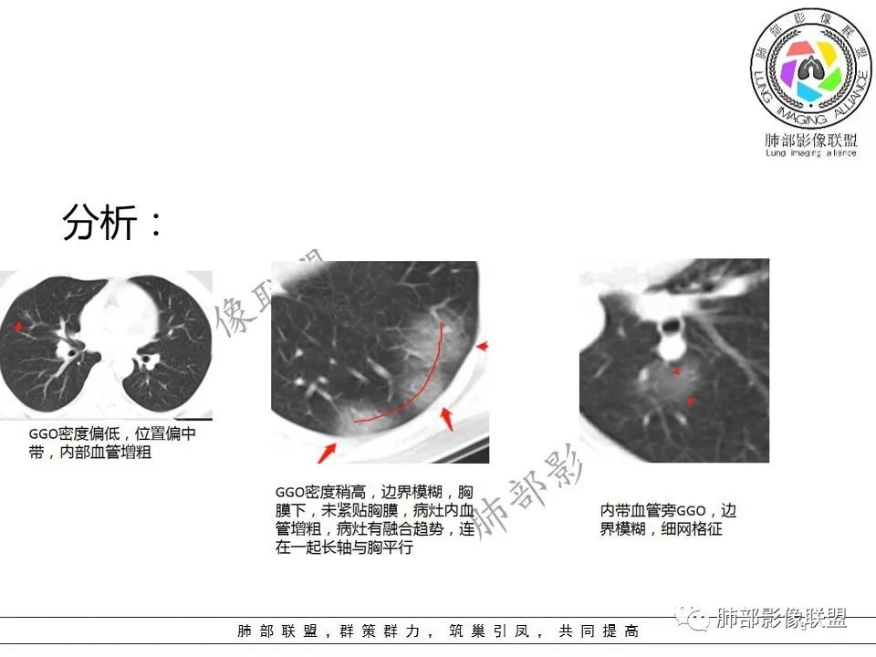 【PPT】关于180余例新冠肺炎(NCP)的影像分析与思考