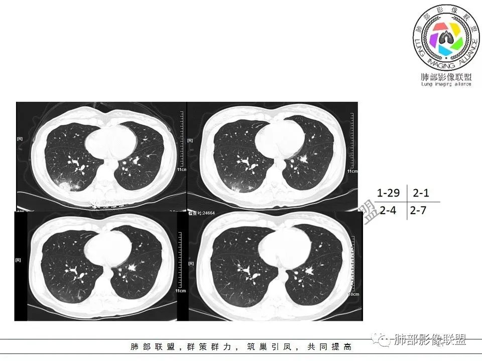 【PPT】关于180余例新冠肺炎(NCP)的影像分析与思考