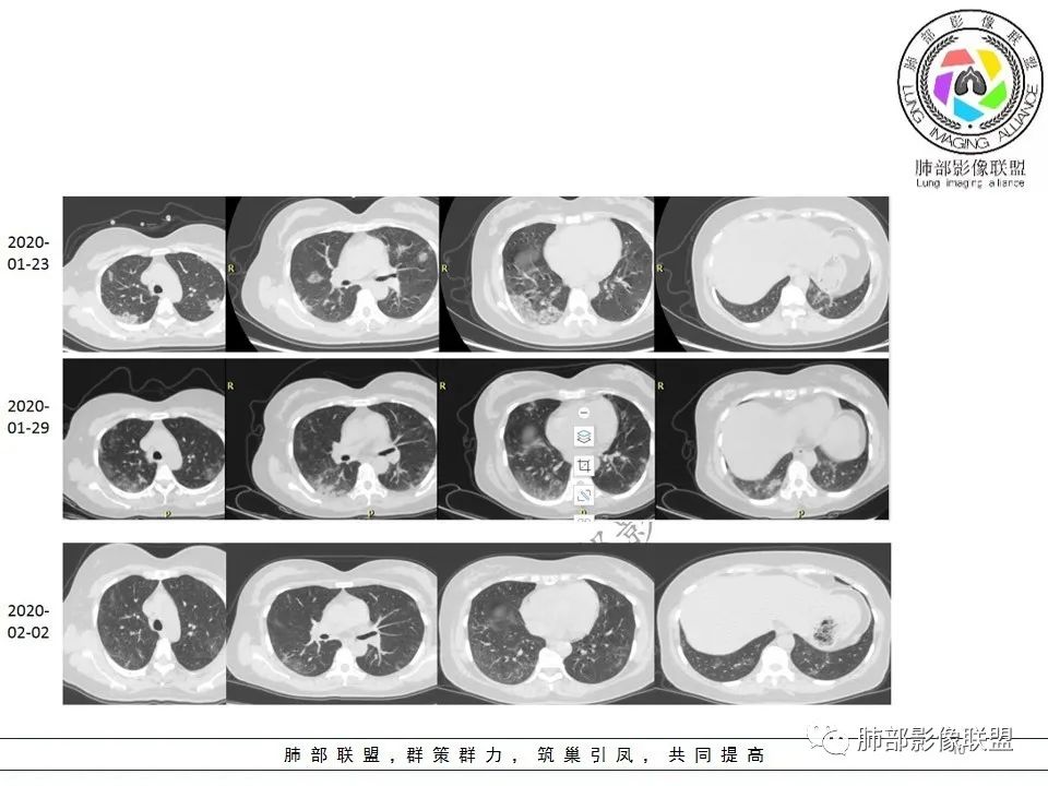 【PPT】关于180余例新冠肺炎(NCP)的影像分析与思考