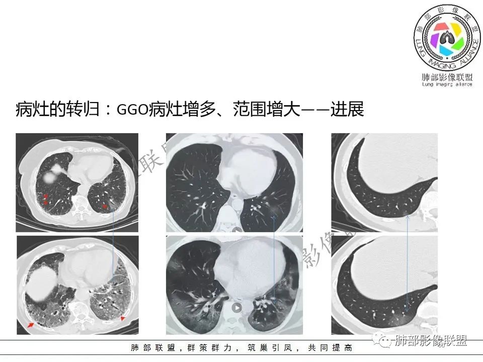【PPT】关于180余例新冠肺炎(NCP)的影像分析与思考
