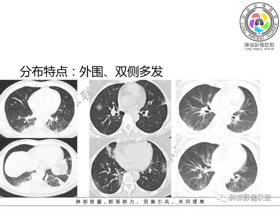 【PPT】关于180余例新冠肺炎(NCP)的影像分析与思考
