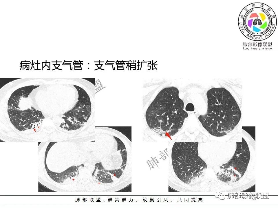 【PPT】关于180余例新冠肺炎(NCP)的影像分析与思考