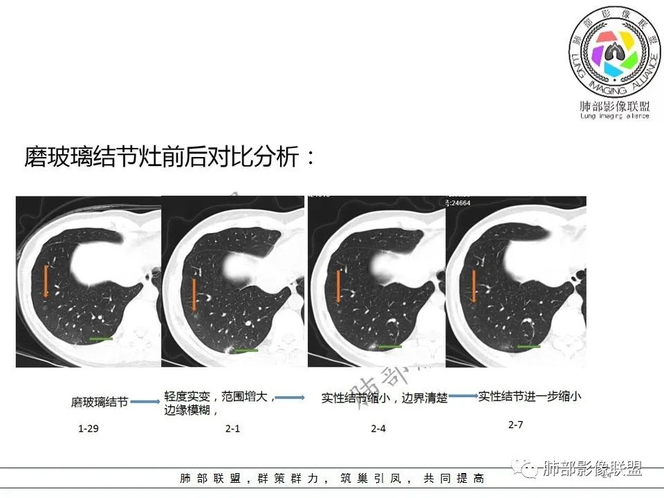 【PPT】关于180余例新冠肺炎(NCP)的影像分析与思考