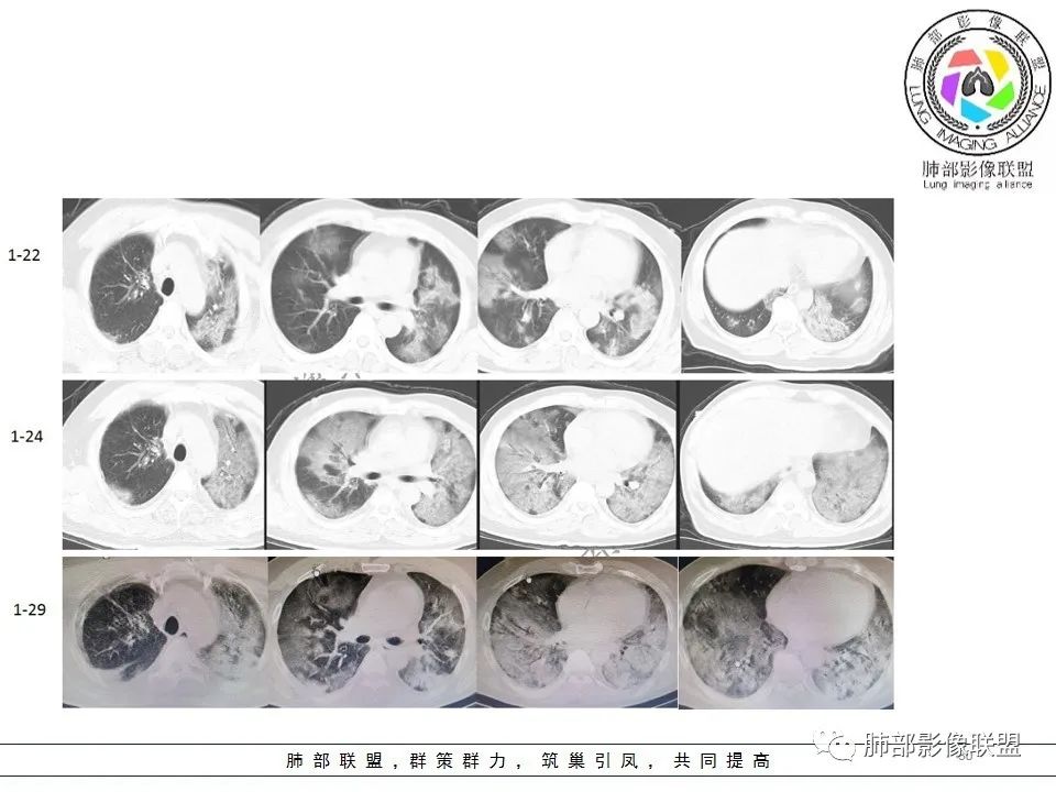 【PPT】关于180余例新冠肺炎(NCP)的影像分析与思考