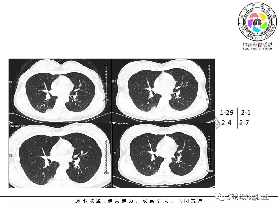【PPT】关于180余例新冠肺炎(NCP)的影像分析与思考