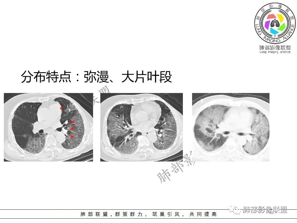 【PPT】关于180余例新冠肺炎(NCP)的影像分析与思考