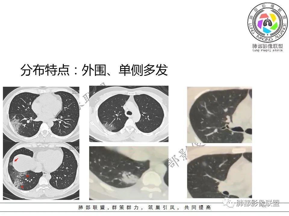 【PPT】关于180余例新冠肺炎(NCP)的影像分析与思考