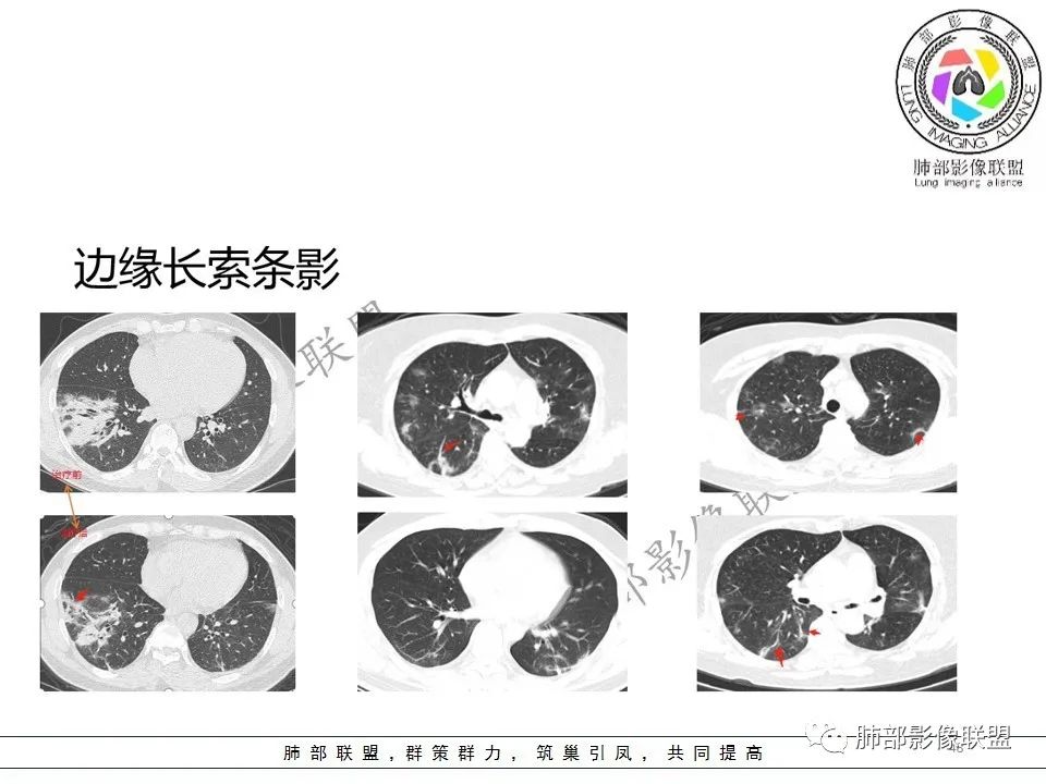 【PPT】关于180余例新冠肺炎(NCP)的影像分析与思考