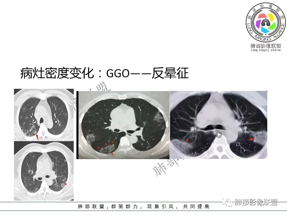 【PPT】关于180余例新冠肺炎(NCP)的影像分析与思考