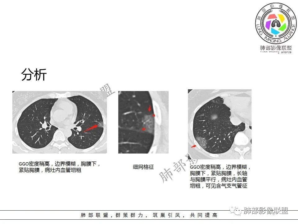 【PPT】关于180余例新冠肺炎(NCP)的影像分析与思考