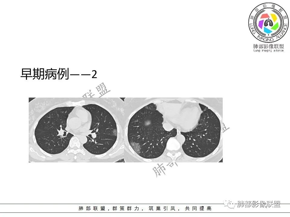 【PPT】关于180余例新冠肺炎(NCP)的影像分析与思考