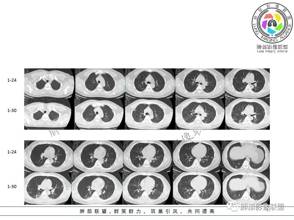 【PPT】关于180余例新冠肺炎(NCP)的影像分析与思考