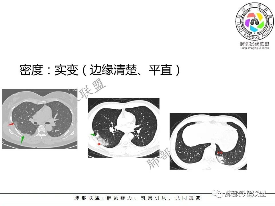 【PPT】关于180余例新冠肺炎(NCP)的影像分析与思考