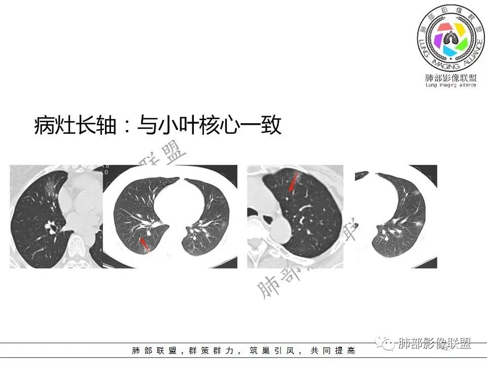 【PPT】关于180余例新冠肺炎(NCP)的影像分析与思考