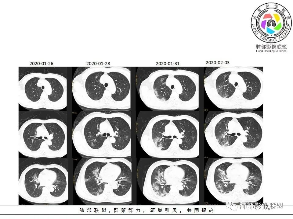 【PPT】关于180余例新冠肺炎(NCP)的影像分析与思考