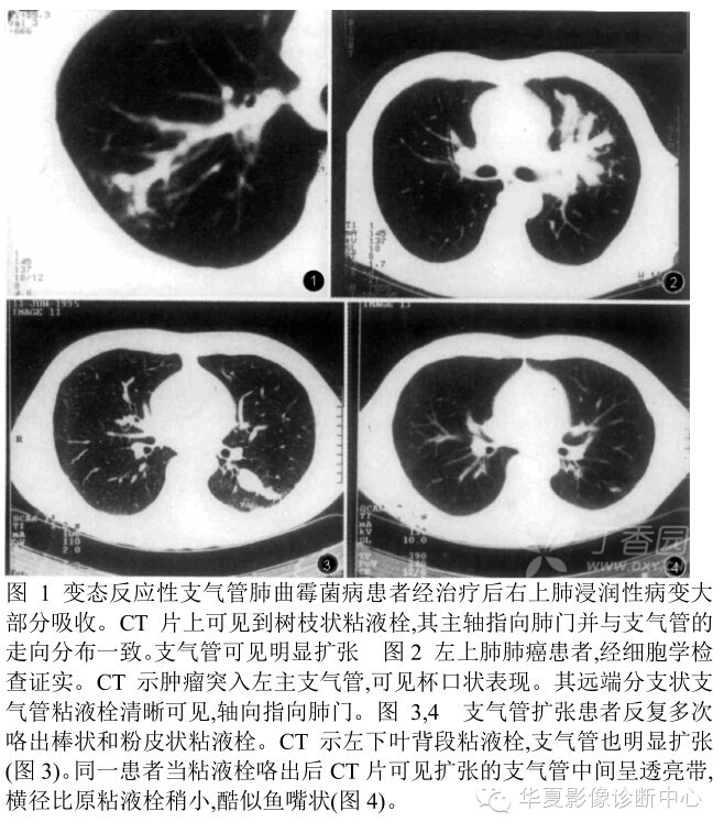 呼吸系统33个影像征象