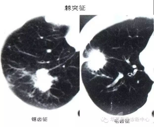 呼吸系统33个影像征象