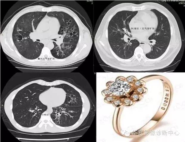 呼吸系统33个影像征象