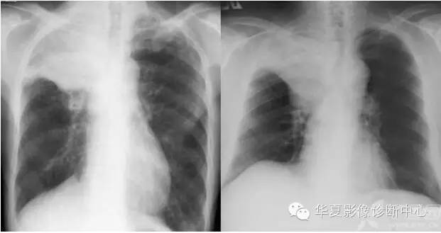 呼吸系统33个影像征象