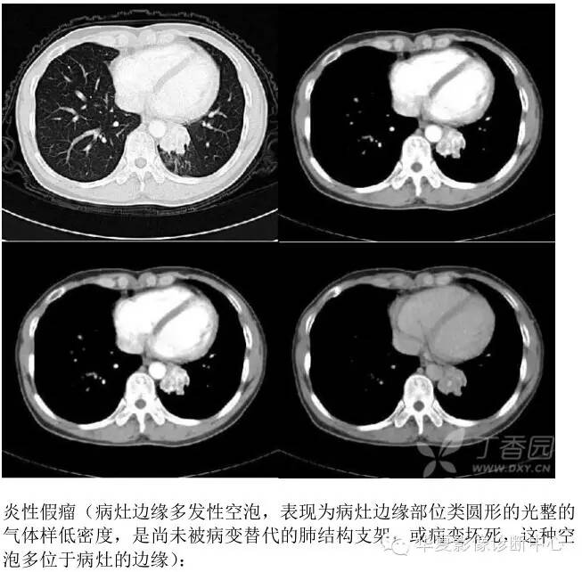 呼吸系统33个影像征象