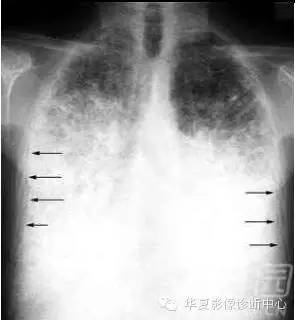 呼吸系统33个影像征象