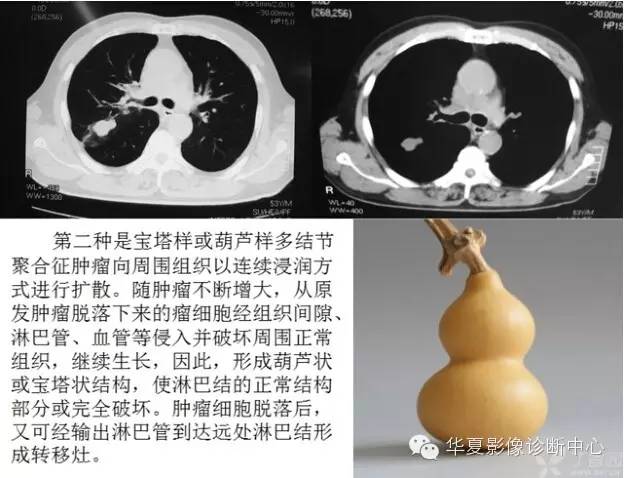 呼吸系统33个影像征象