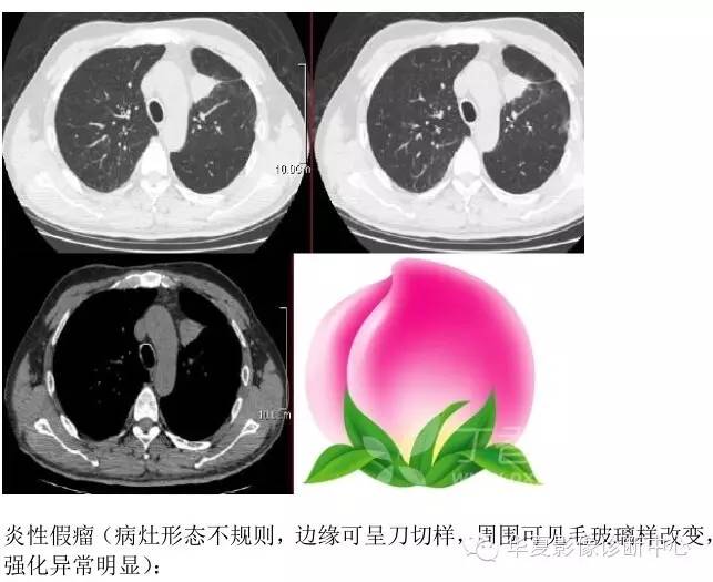 呼吸系统33个影像征象
