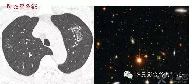 呼吸系统33个影像征象