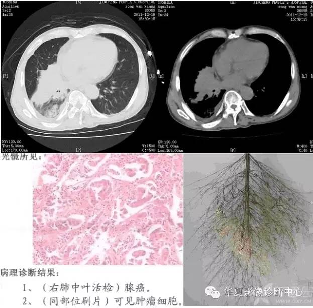 呼吸系统33个影像征象