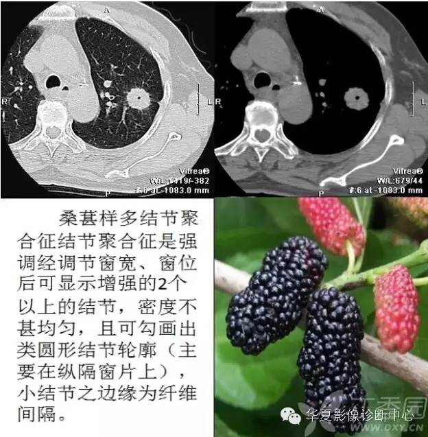 呼吸系统33个影像征象