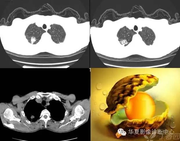 呼吸系统33个影像征象