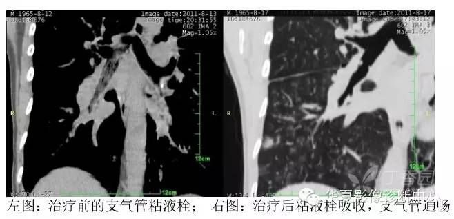 呼吸系统33个影像征象