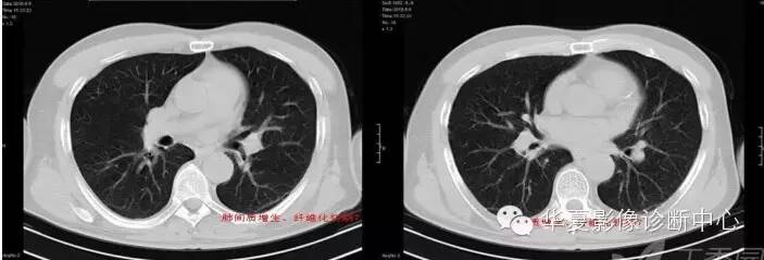 呼吸系统33个影像征象
