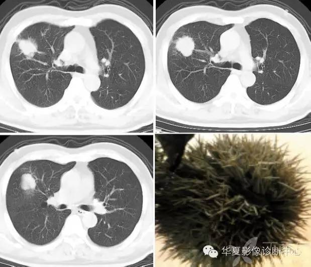 呼吸系统33个影像征象