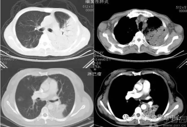 呼吸系统33个影像征象