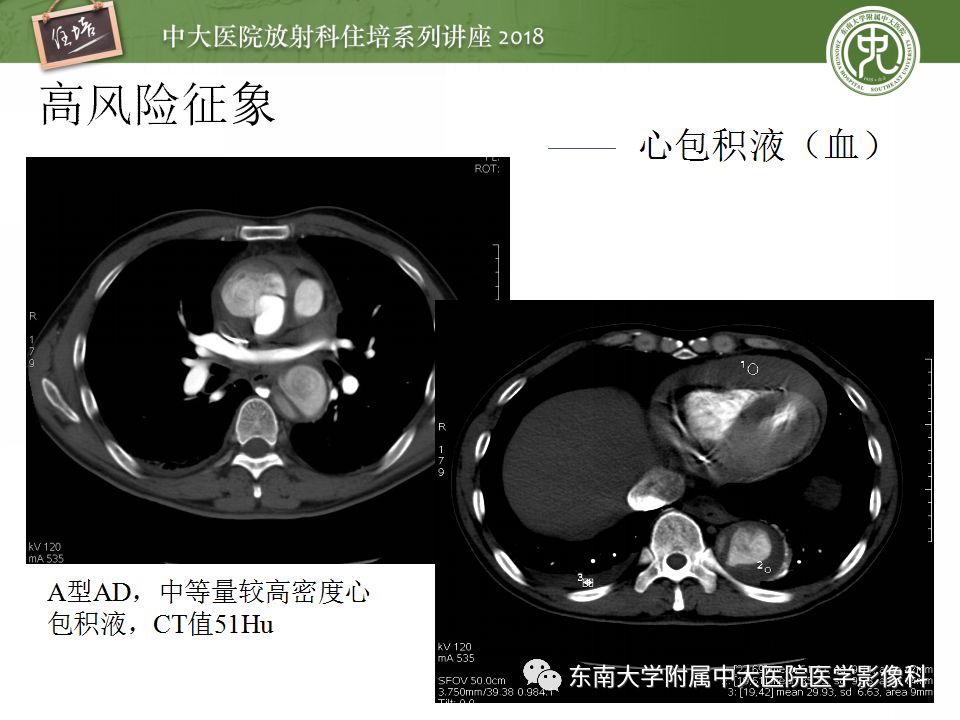 【PPT】急性主动脉综合征的CTA诊断与高风险征象