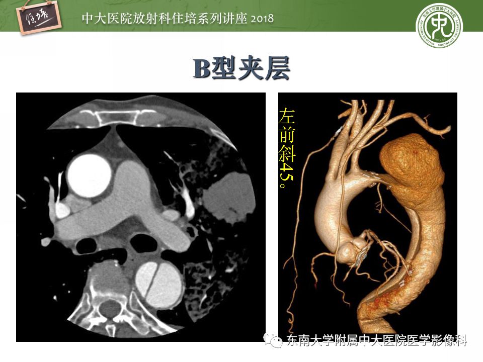 【PPT】急性主动脉综合征的CTA诊断与高风险征象