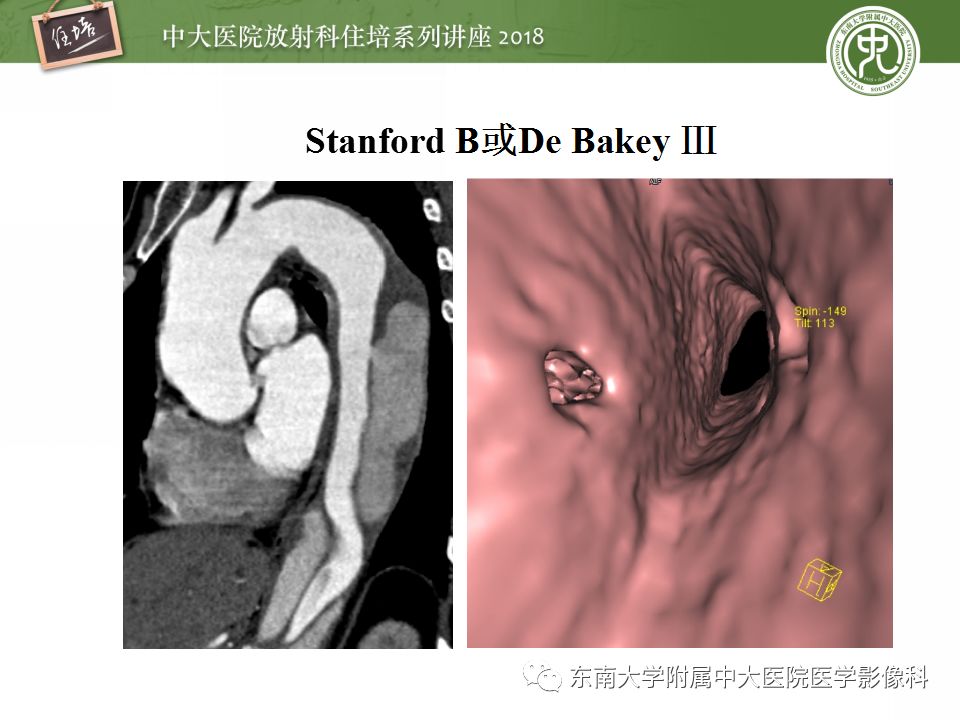 【PPT】急性主动脉综合征的CTA诊断与高风险征象