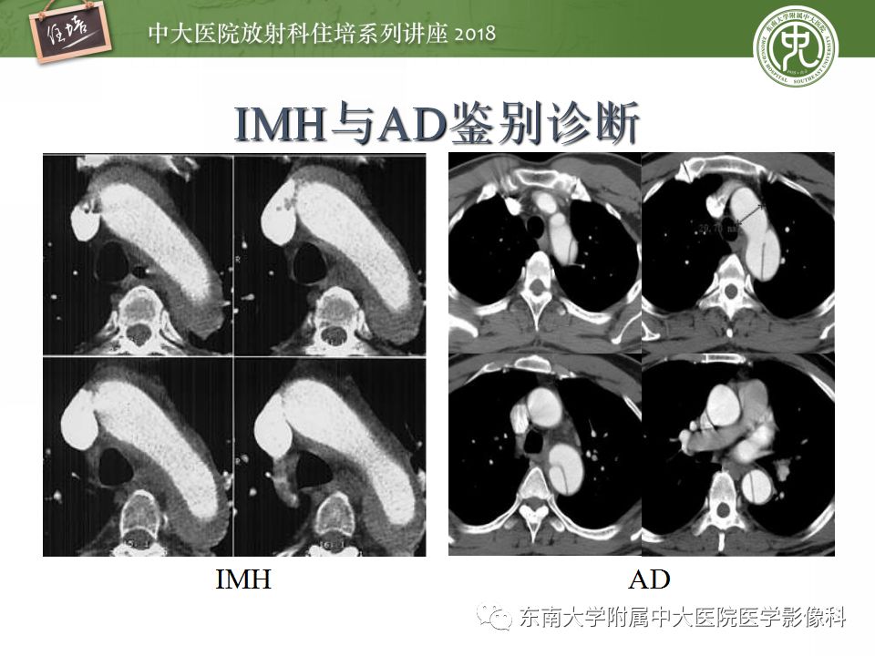 【PPT】急性主动脉综合征的CTA诊断与高风险征象