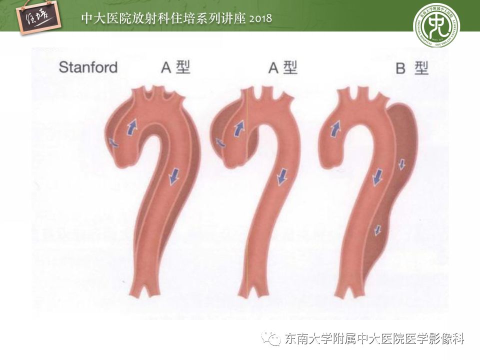 【PPT】急性主动脉综合征的CTA诊断与高风险征象