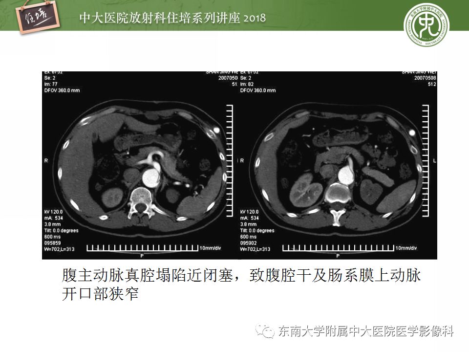 【PPT】急性主动脉综合征的CTA诊断与高风险征象